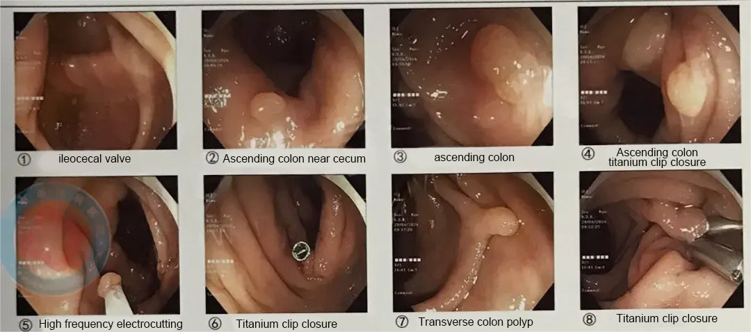 Picha ya matumbo ya endoscopic