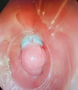 Esophageal variceal ligation (EVL)