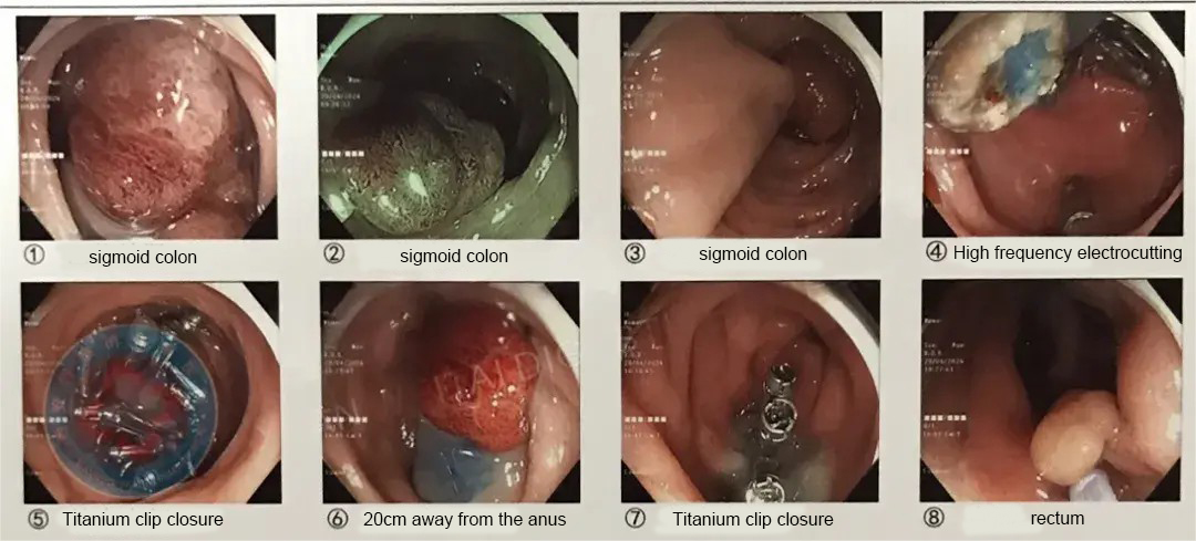 Isithombe se-Endoscopic yamathumbu