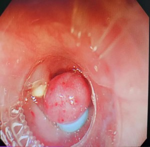 Esophageal variceal ligering (EVL)