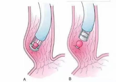 Esophageal variceal ligation (EVL)