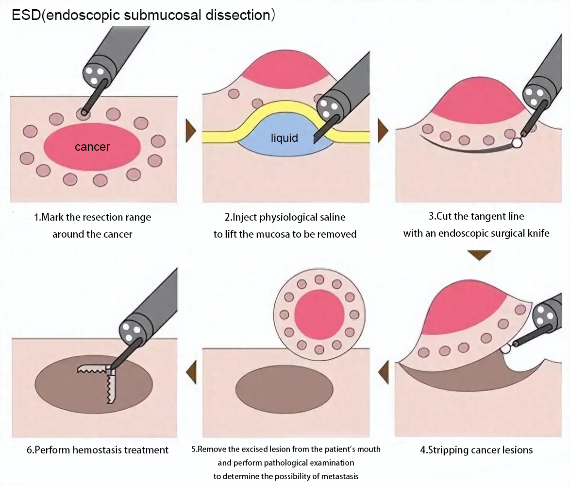 ESD（endoscopic submucosal dissection）